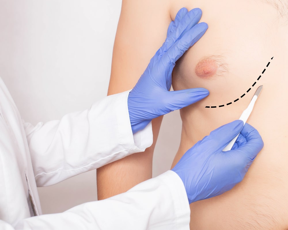 Doctor,Plastic,Surgeon,With,Scalpel,Near,Male,Patient's,Chest.,Male Male Breast Reduction Cleveland OH